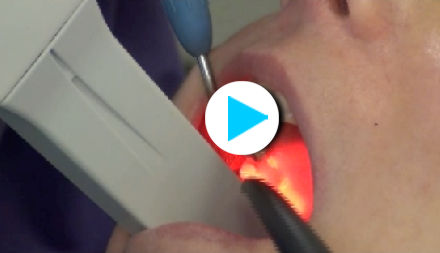 Funktionsweise eines Scannvorganges im Mund - Vorschaubild zum Video © HERAEUS -Werksfoto